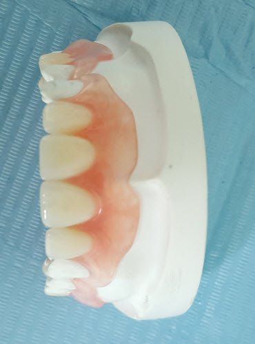 Flexible Denture
