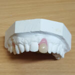 Acrylic Partial Dentures