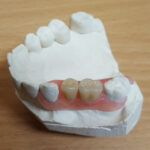 Flexi Denture and ComFlexin Dentures