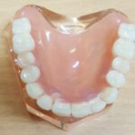 Acrylic Partial Dentures