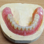 Acrylic Partial Dentures