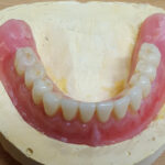 Acrylic Partial Dentures