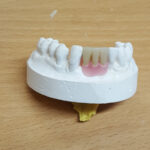 Acrylic Partial Dentures