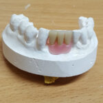 Acrylic Partial Dentures