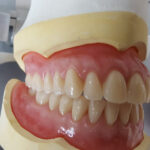 Acrylic Partial Dentures