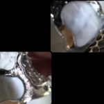 Chrome Cobalt Dentures