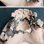 Chrome Cobalt Dentures