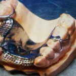Chrome Cobalt Dentures