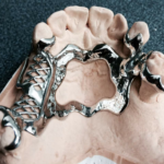 Acrylic Partial Dentures