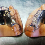 Chrome Cobalt Dentures