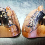 Chrome Cobalt Dentures