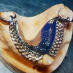 Chrome Cobalt Dentures