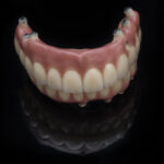 Screw Retained Bridge